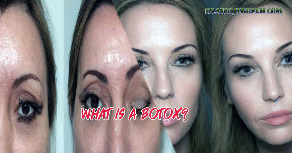 What is a botox