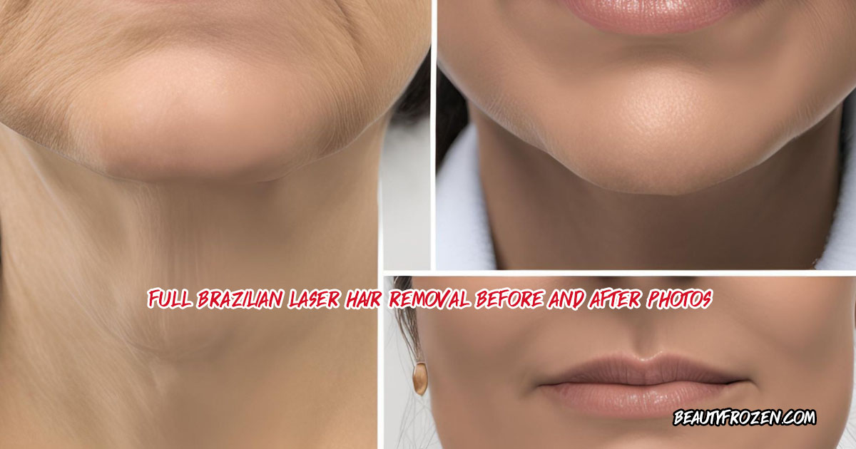 Full Brazilian Laser Hair Removal before and after photos