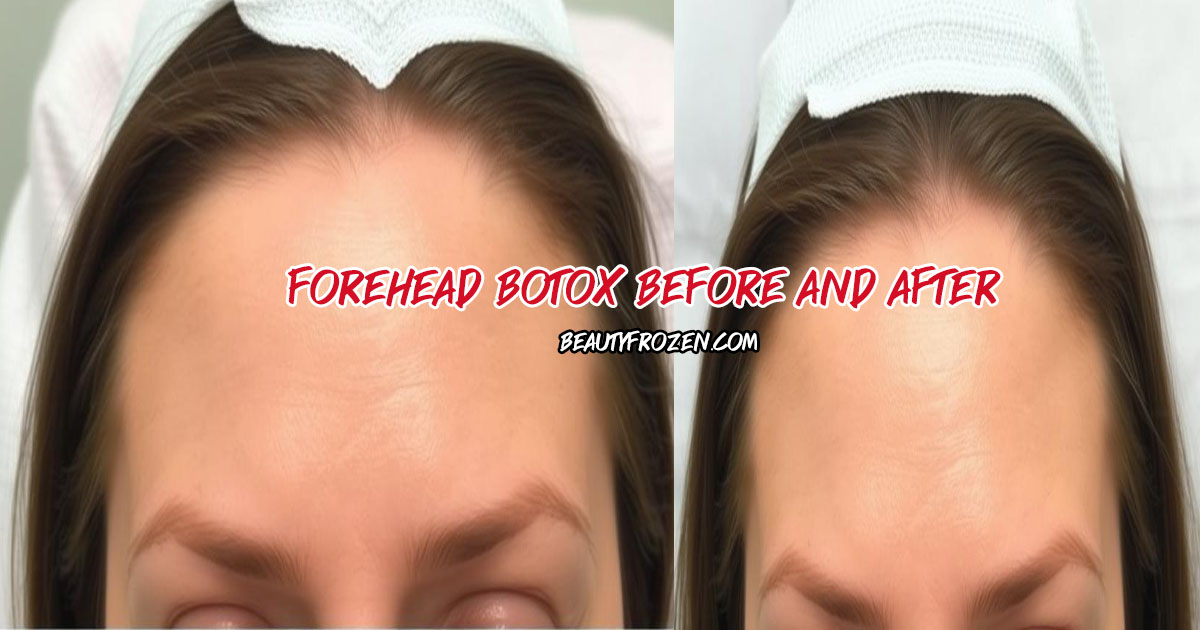 Forehead Botox Before and After